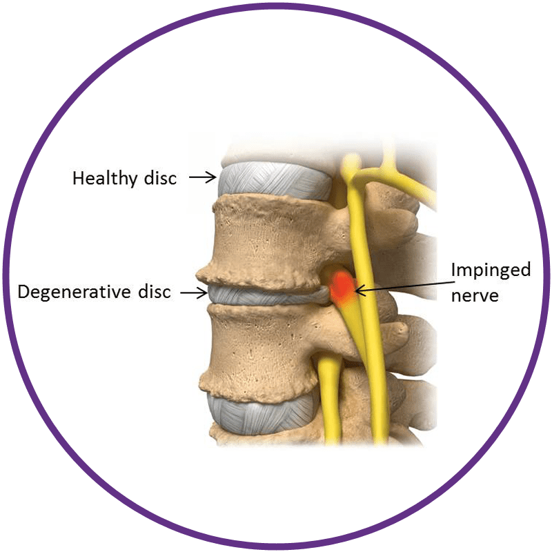 decompression-therapy-syracuse-medical-live-a-pain-free-life